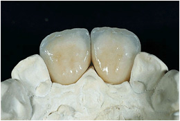 Prótese Metalocerâmica