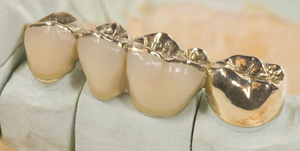 Prótese Parcial Fixa